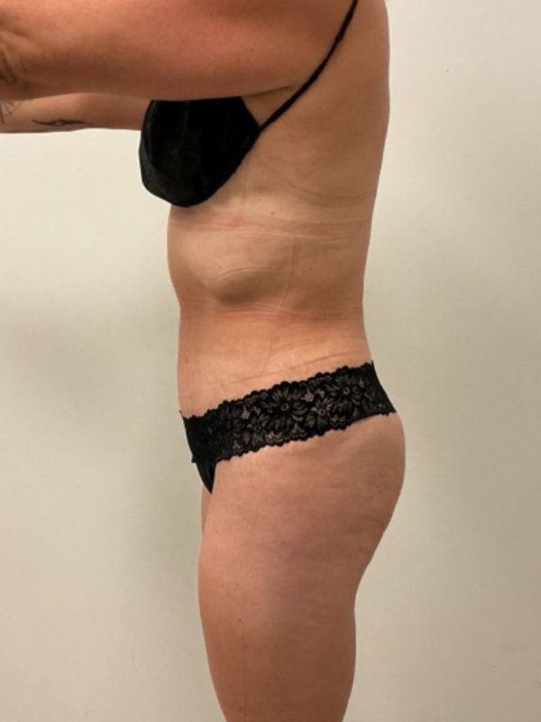 Liposuction - Dr. Obi Before & After Image