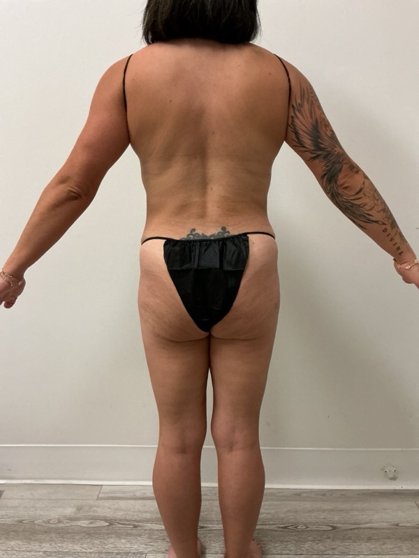 Liposuction - Dr. Obi Before & After Image