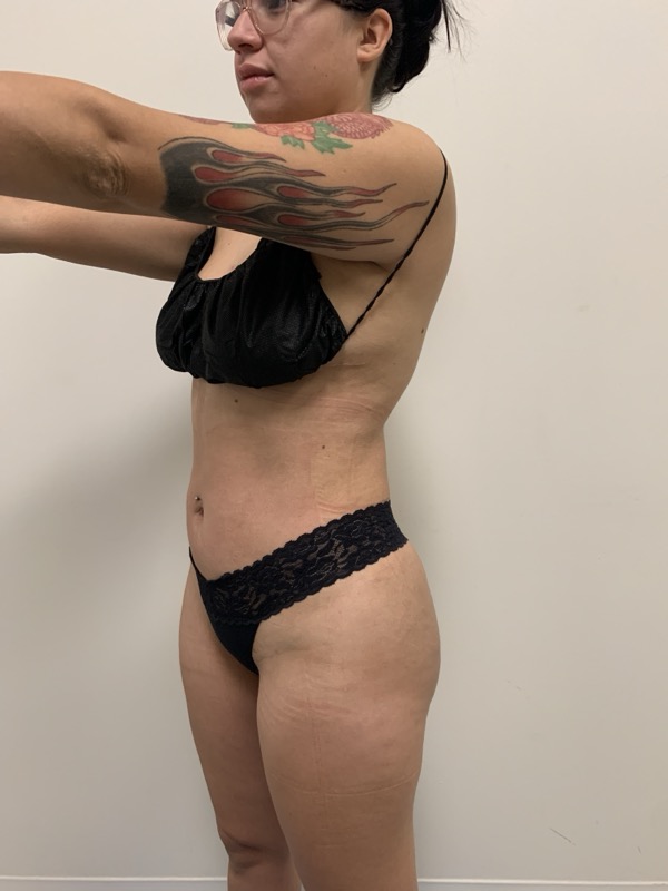Liposuction - Dr. Obi Before & After Image