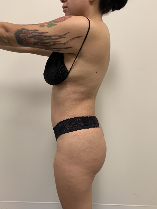 Liposuction - Dr. Obi Before & After Image