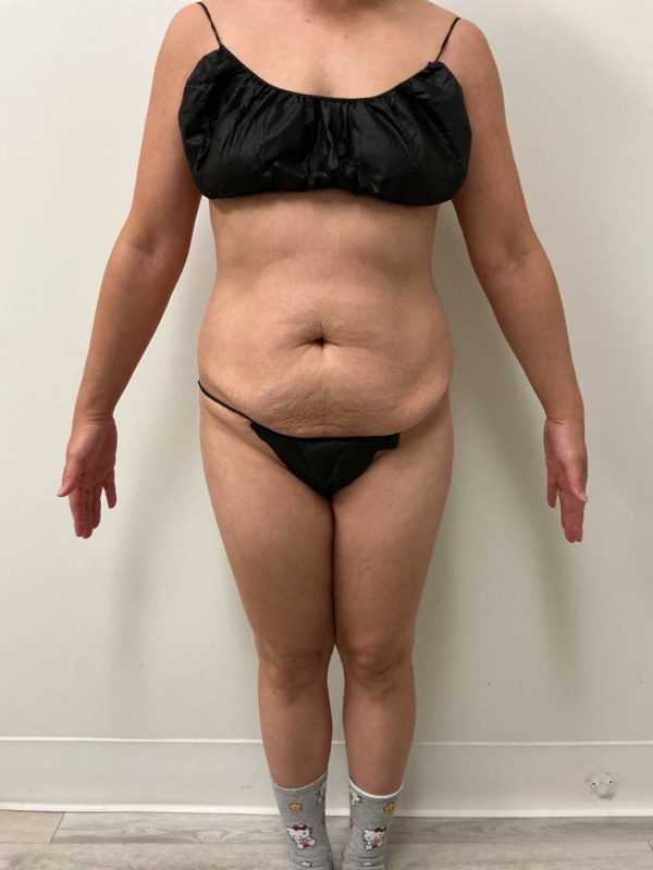 Liposuction - Dr. Obi Before & After Image