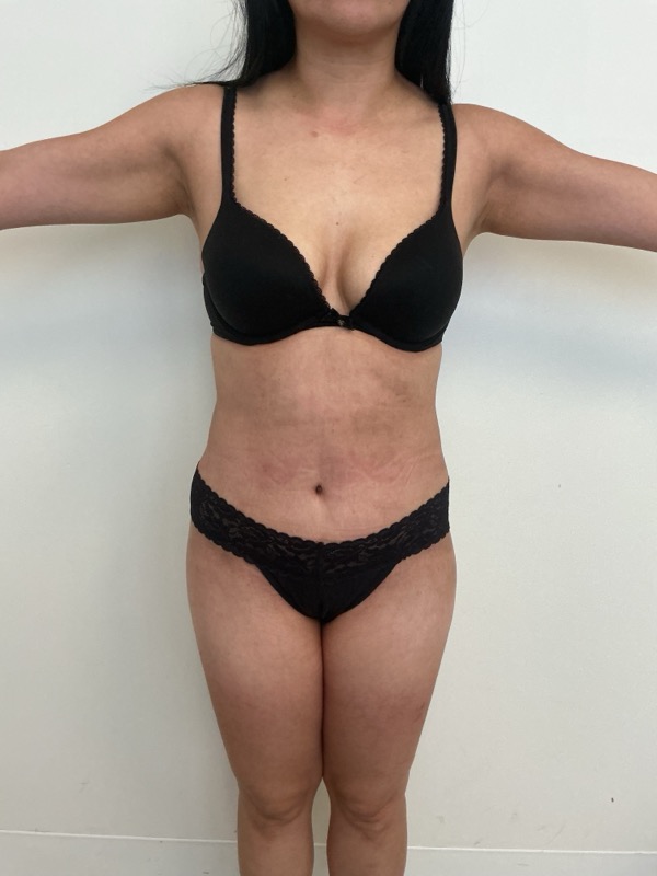 Liposuction - Dr. Obi Before & After Image