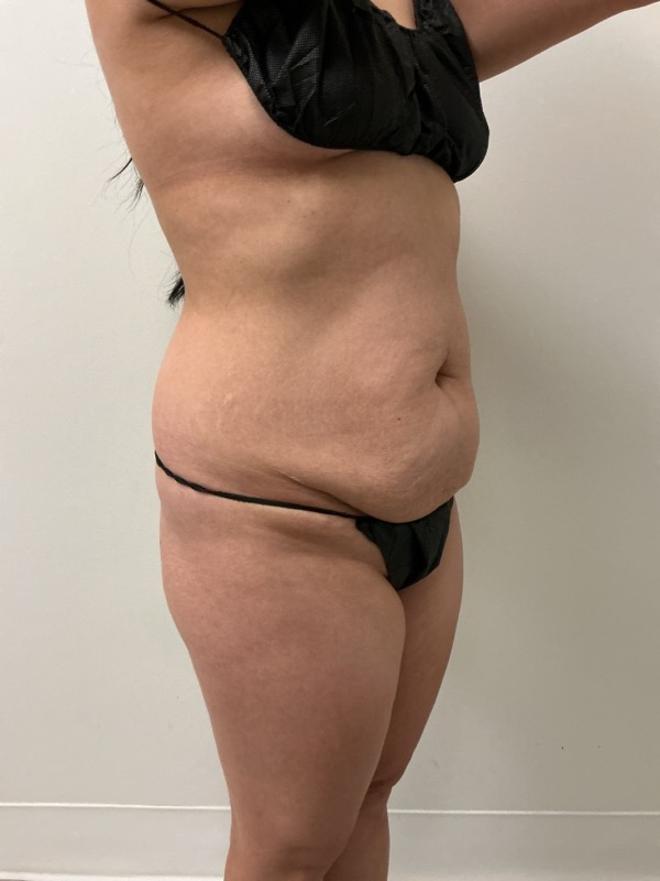 Liposuction - Dr. Obi Before & After Image