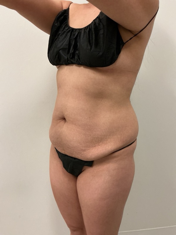 Liposuction - Dr. Obi Before & After Image
