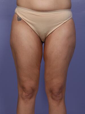 Liposuction Before & After Image