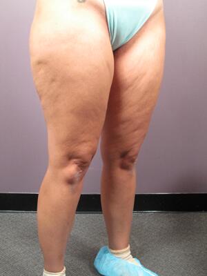 Liposuction Before & After Image