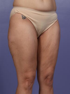 Liposuction Before & After Image