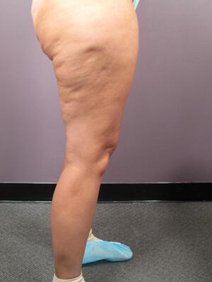 Liposuction Before & After Image