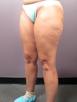 Liposuction Before & After Image