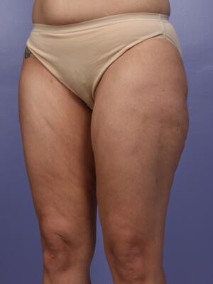 Liposuction Before & After Image