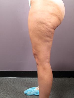 Liposuction Before & After Image