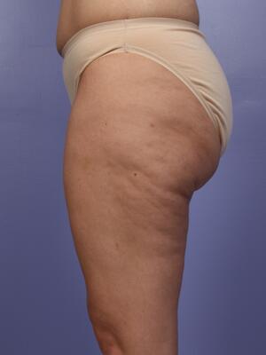 Liposuction Before & After Image