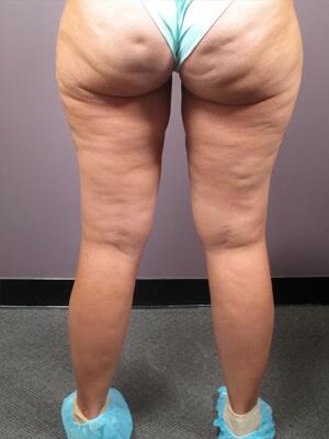 Liposuction Before & After Image