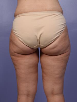 Liposuction Before & After Image