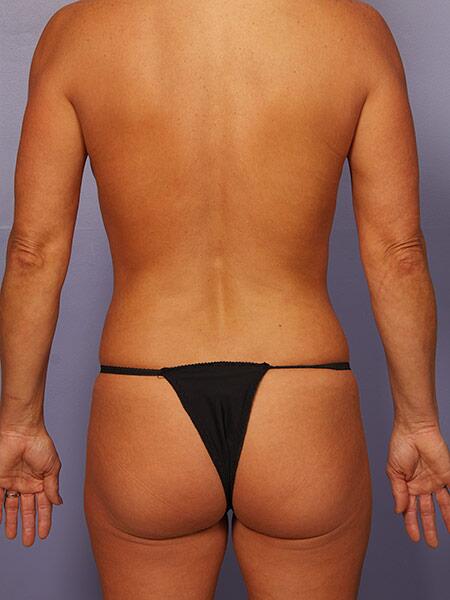 Liposuction Before & After Image