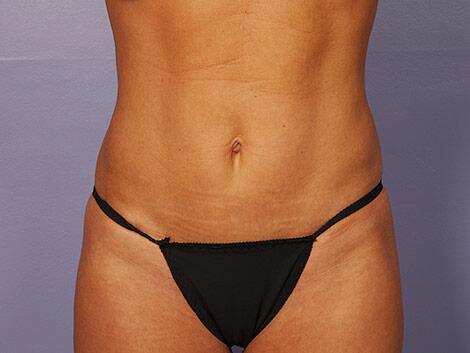 Liposuction Before & After Image