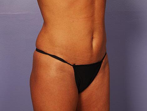 Liposuction Before & After Image