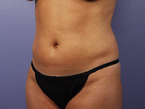 Liposuction Before & After Image