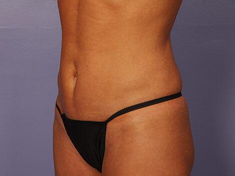 Liposuction Before & After Image