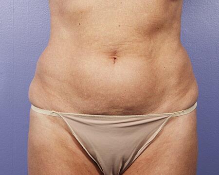 Liposuction Before & After Image