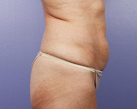 Liposuction Before & After Image