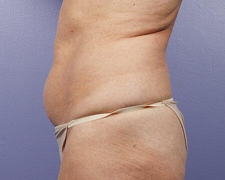 Liposuction Before & After Image