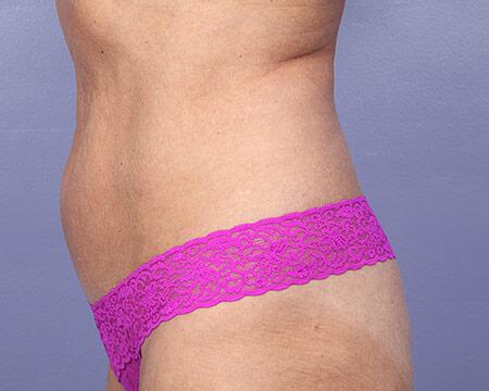 Liposuction Before & After Image