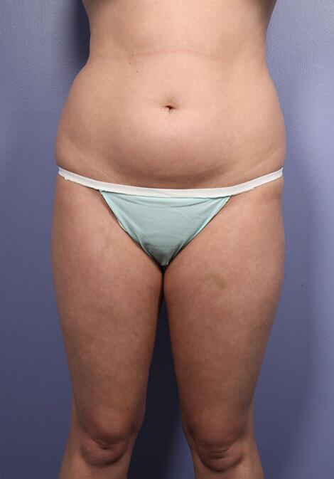 Liposuction Before & After Image