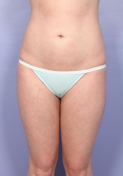 Liposuction Before & After Image