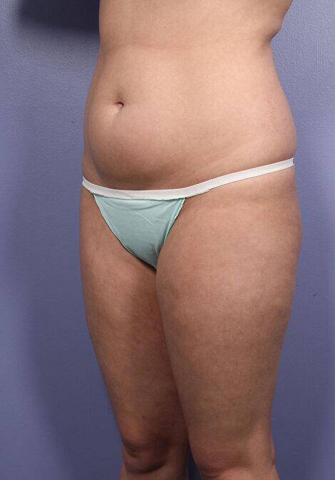 Liposuction Before & After Image