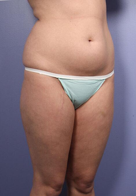 Liposuction Before & After Image