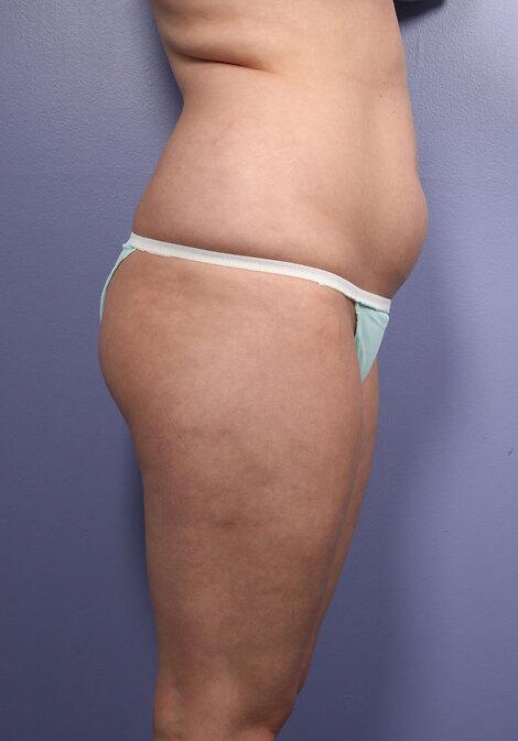 Liposuction Before & After Image