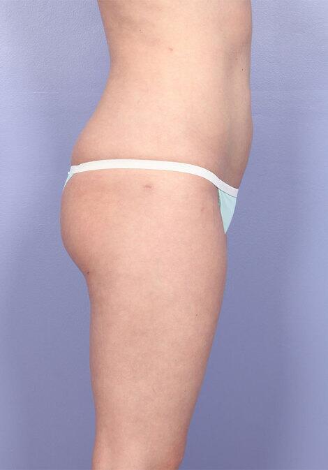 Liposuction Before & After Image