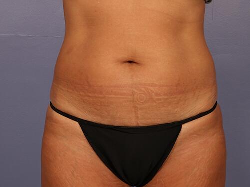 Liposuction Before & After Image