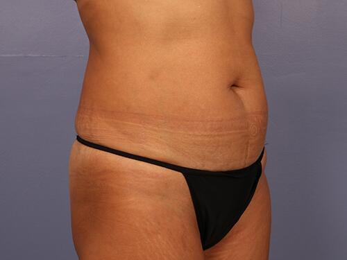 Liposuction Before & After Image