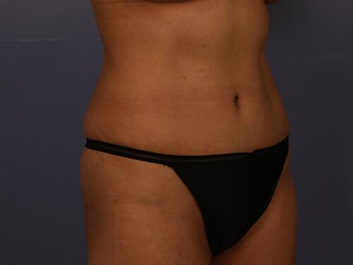 Liposuction Before & After Image