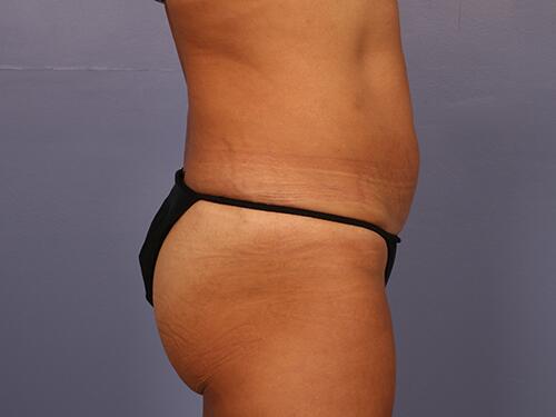 Liposuction Before & After Image