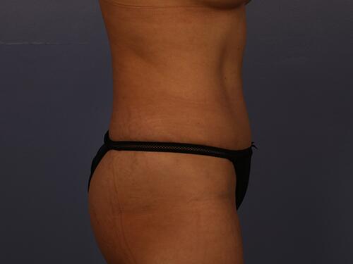 Liposuction Before & After Image