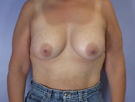 Liposuction Before & After Image