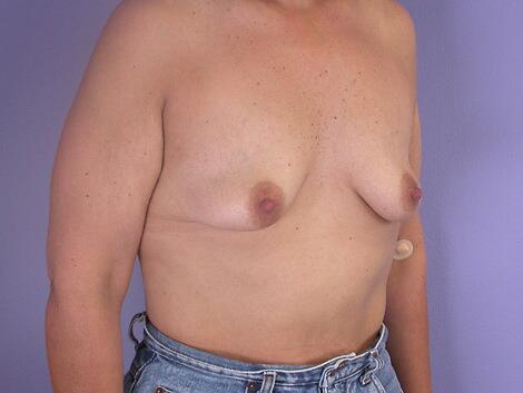 Liposuction Before & After Image