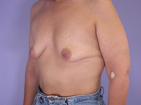 Liposuction Before & After Image