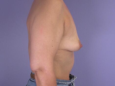 Liposuction Before & After Image