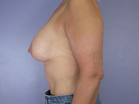 Liposuction Before & After Image