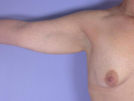 Liposuction Before & After Image