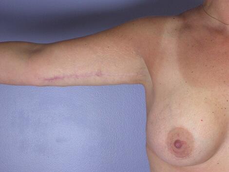 Liposuction Before & After Image