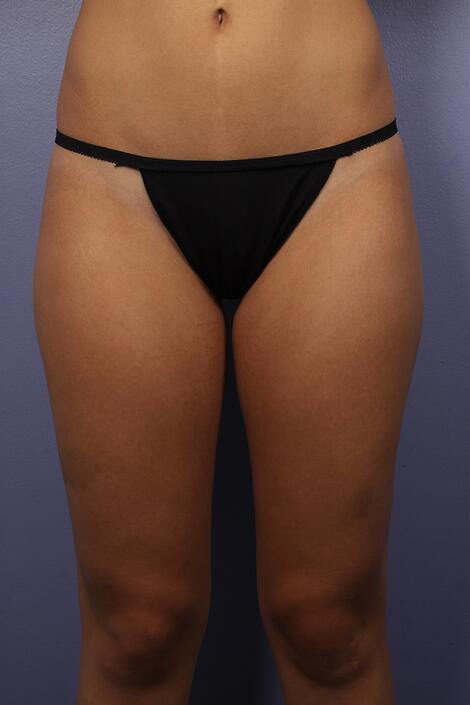 Liposuction Before & After Image