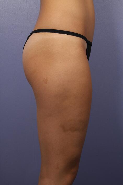 Liposuction Before & After Image