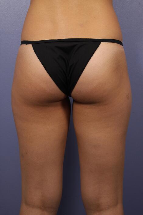 Liposuction Before & After Image