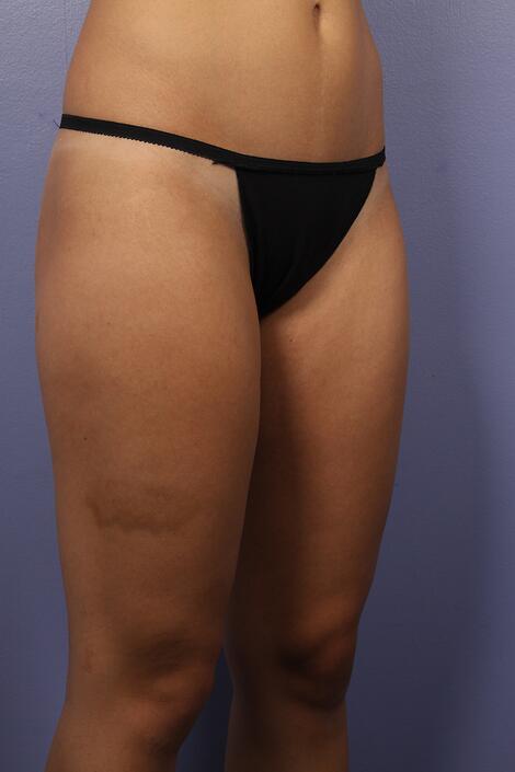 Liposuction Before & After Image