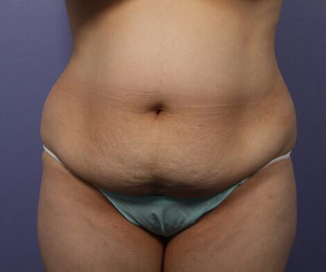 Liposuction Before & After Image